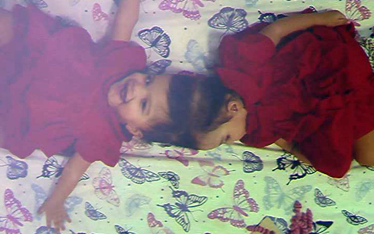 Gêmeas siamesas passam por segunda cirurgia para separação dos crânios no HC de Ribeirão Preto, SP