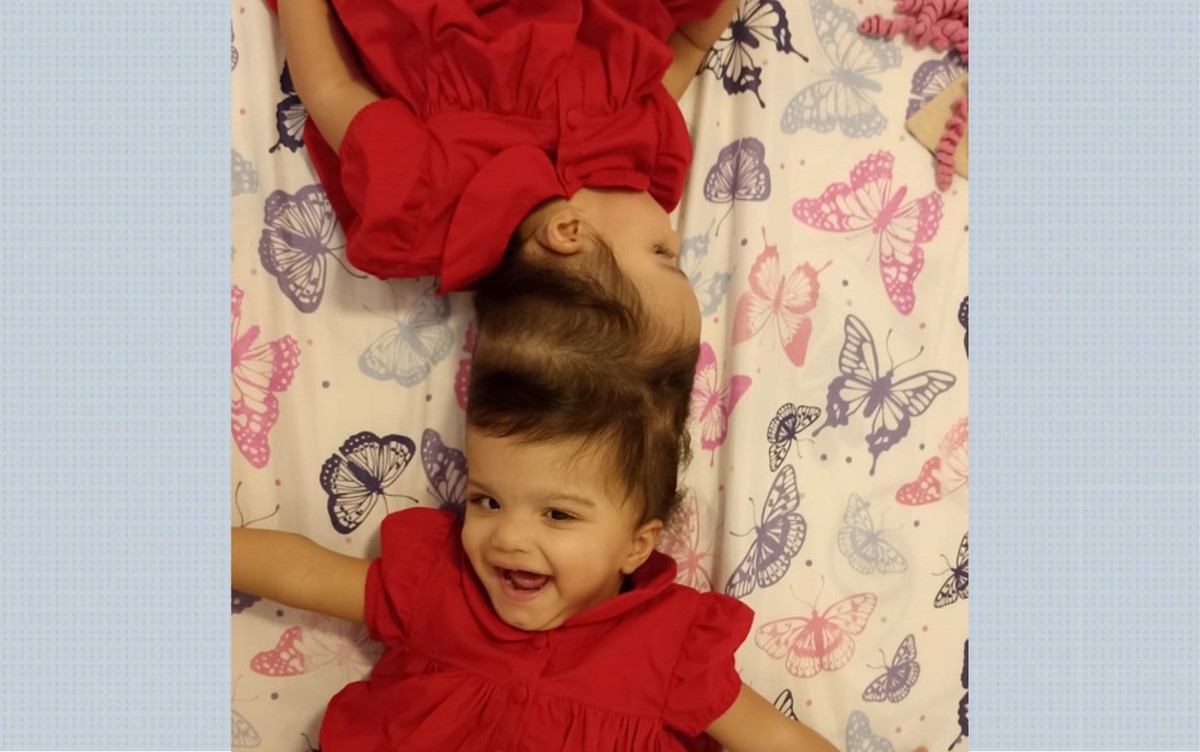 Metaverso, impressão 3D e ‘GPS cerebral’: conheça tecnologias por trás da separação de siamesas em Ribeirão Preto, SP