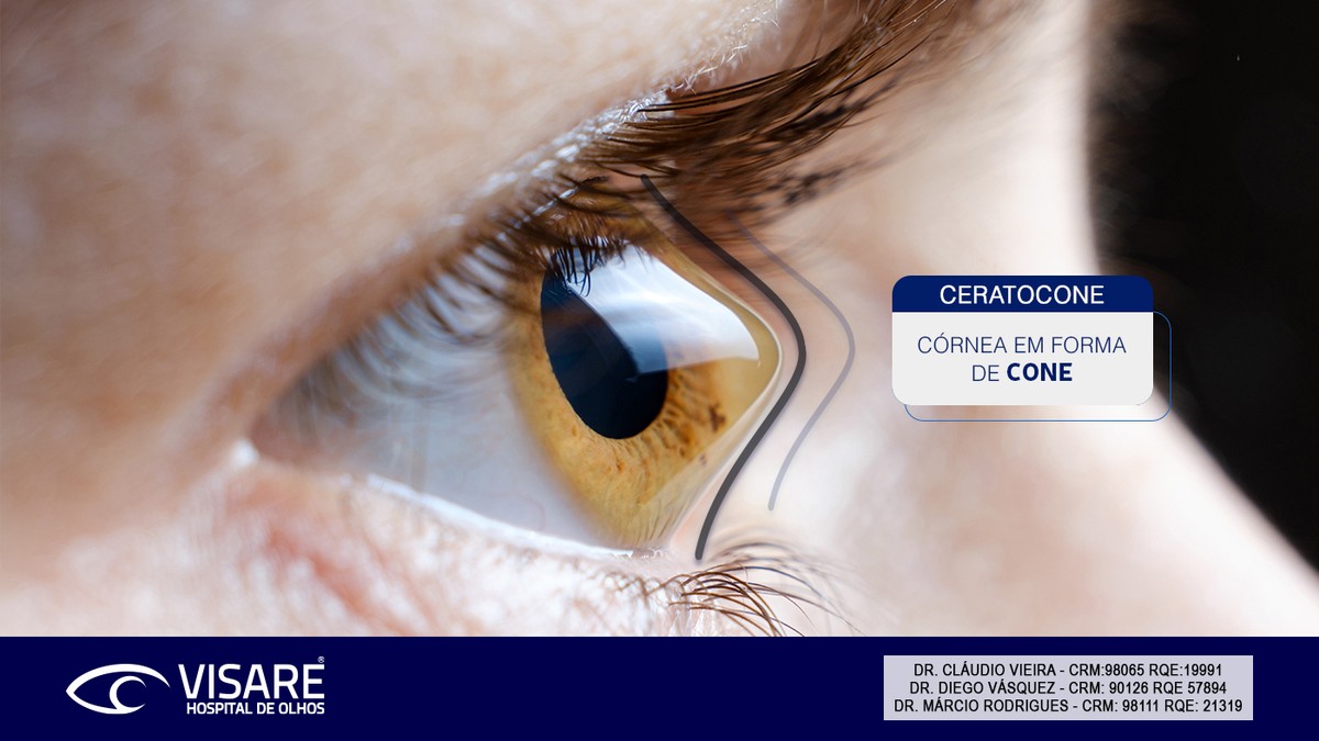 Ceratocone: o que é, causas, sintomas e tratamentos | Especial Publicitário – Visare Hospital de Olhos