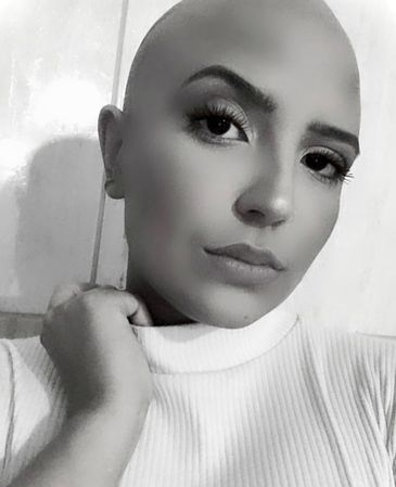 28/09/2023, Matéria Sobre Alopecia areata. Na foto a personagem Yasmin Torquato. Foto: Arquivo Pessoal